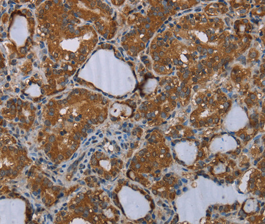 Immunohistochemistry of paraffin-embedded Human thyroid cancer tissue using MEIS1 Polyclonal Antibody at dilution 1:30