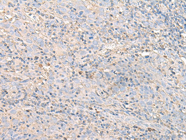 Immunohistochemistry of paraffin-embedded Human cervical cancer tissue  using IGHA1 Polyclonal Antibody at dilution of 1:50(?200)