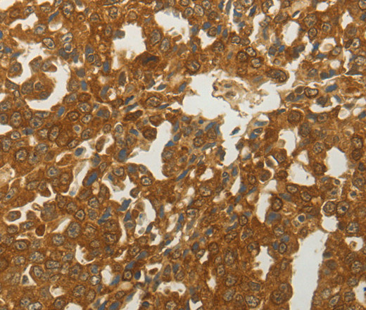 Immunohistochemistry of paraffin-embedded Human lung cancer tissue using MC4R Polyclonal Antibody at dilution 1:50