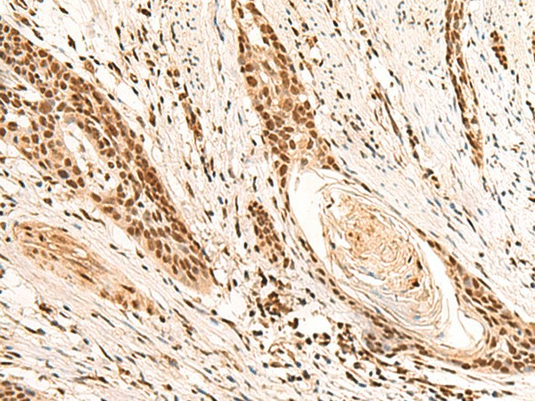 Immunohistochemistry of paraffin-embedded Human esophagus cancer tissue  using RMND5B Polyclonal Antibody at dilution of 1:50(?200)