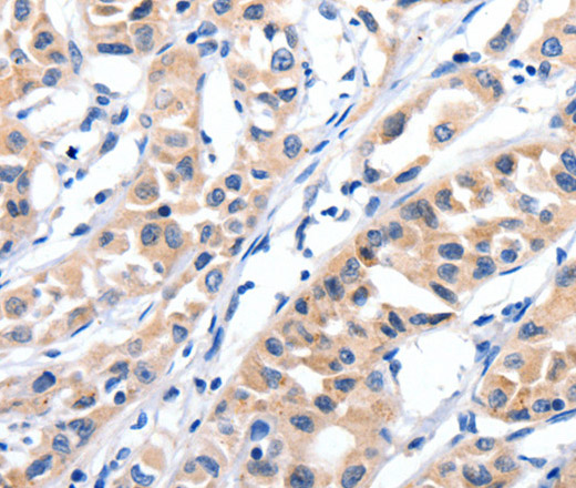 Immunohistochemistry of paraffin-embedded Human lung cancer tissue using JAK2 Polyclonal Antibody at dilution 1:35