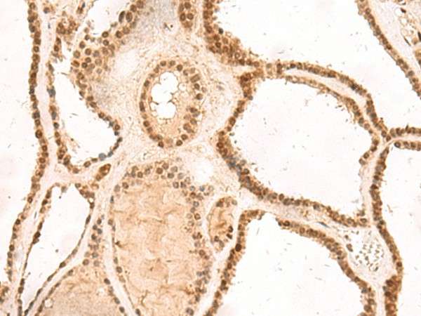 Immunohistochemistry of paraffin-embedded Human thyroid cancer tissue  using MKX Polyclonal Antibody at dilution of 1:60(?200)