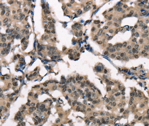 Immunohistochemistry of paraffin-embedded Human breast cancer using NSMCE3 Polyclonal Antibody at dilution of 1:40