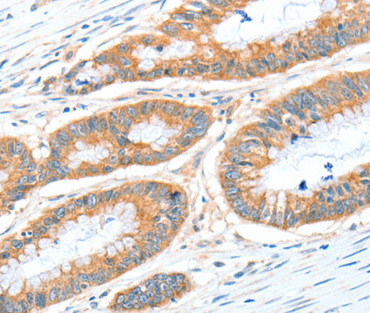 Immunohistochemistry of paraffin-embedded Human colon cancer tissue using ALDH1A2 Polyclonal Antibody at dilution 1:30