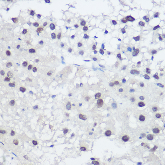 Immunohistochemistry of paraffin-embedded human liver cancer using GADD45A Polyclonal Antibody at dilution of 1:200 (40x lens).Perform high pressure antigen retrieval with 10 mM citrate buffer pH 6.0 before commencing with IHC staining protocol.