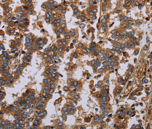 Immunohistochemistry of paraffin-embedded Human liver cancer using GDF2 Polyclonal Antibody at dilution of 1:40