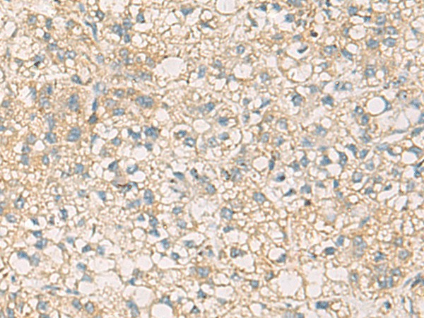 Immunohistochemistry of paraffin-embedded Human liver cancer tissue  using STX6 Polyclonal Antibody at dilution of 1:45(?200)