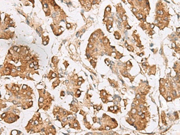 Immunohistochemistry of paraffin-embedded Human gastric cancer tissue  using SLC40A1 Polyclonal Antibody at dilution of 1:65(?200)