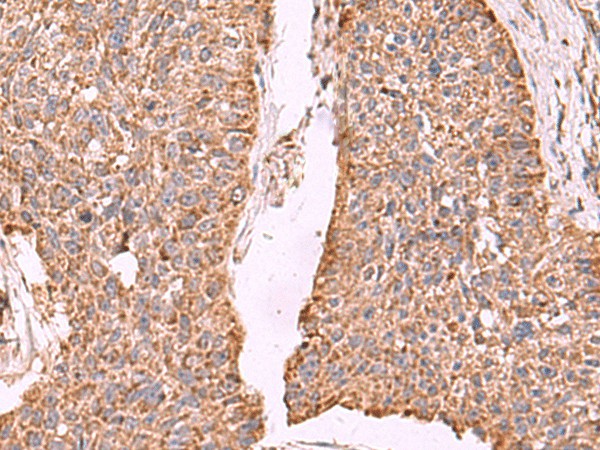 Immunohistochemistry of paraffin-embedded Human esophagus cancer tissue  using PER3 Polyclonal Antibody at dilution of 1:55(?200)