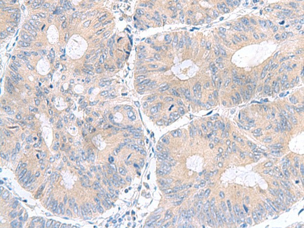 Immunohistochemistry of paraffin-embedded Human colorectal cancer tissue  using UBE2F Polyclonal Antibody at dilution of 1:100(?200)