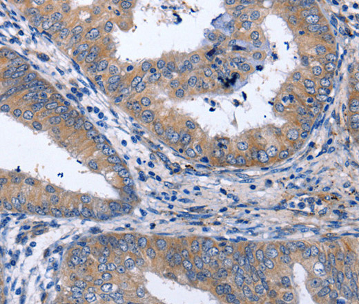 Immunohistochemistry of paraffin-embedded Human cervical cancer tissue using NPPB Polyclonal Antibody at dilution 1:40