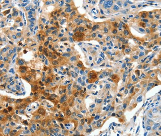 Immunohistochemistry of paraffin-embedded Human lung cancer tissue using COG1 Polyclonal Antibody at dilution 1:60