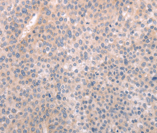 Immunohistochemistry of paraffin-embedded Human liver cancer tissue using ABCF1 Polyclonal Antibody at dilution 1:40