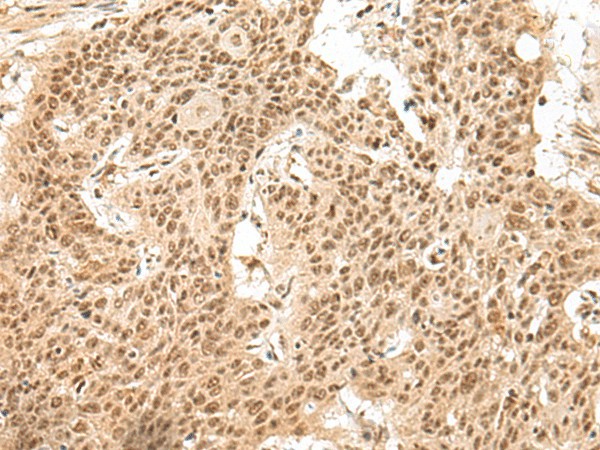 Immunohistochemistry of paraffin-embedded Human esophagus cancer tissue  using GMEB2 Polyclonal Antibody at dilution of 1:30(?200)