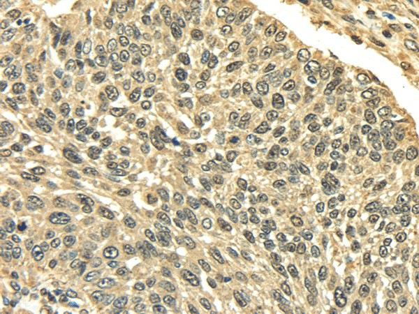 Immunohistochemistry of paraffin-embedded Human lung cancer using PLIN3 Polyclonal Antibody at dilution of  1/35