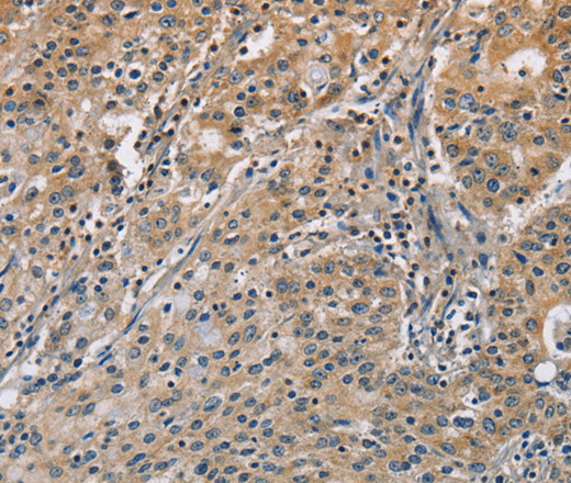 Immunohistochemistry of paraffin-embedded Human gastric cancer tissue using DNMT3A Polyclonal Antibody at dilution 1:50