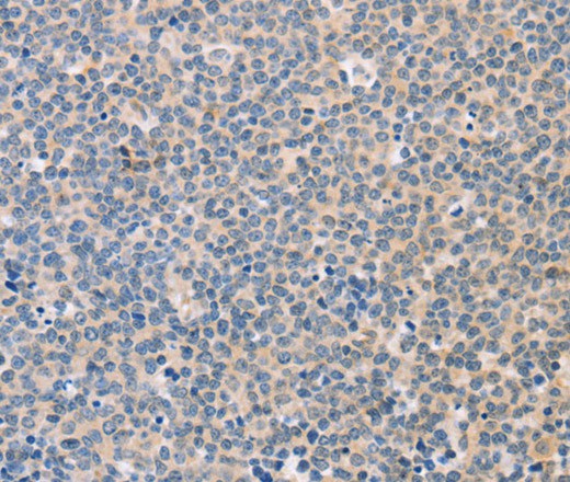 Immunohistochemistry of paraffin-embedded Human Lymphoma tissue using CD56 Polyclonal Antibody at dilution 1:30