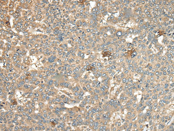 Immunohistochemistry of paraffin-embedded Human liver cancer tissue  using CA11 Polyclonal Antibody at dilution of 1:45(?200)