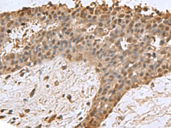 Immunohistochemistry of paraffin-embedded Human breast cancer tissue  using DCTPP1 Polyclonal Antibody at dilution of 1:85(?200)