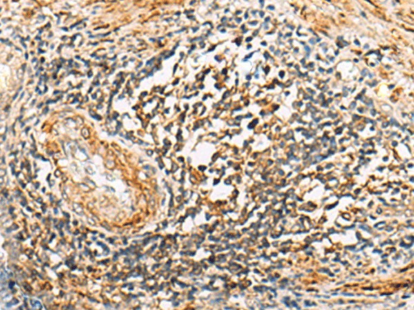 Immunohistochemistry of paraffin-embedded Human prost ate cancer tissue  using NLRC4 Polyclonal Antibody at dilution of 1:50(?200)