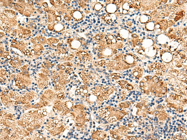 Immunohistochemistry of paraffin-embedded Human gastric cancer tissue  using NEGR1 Polyclonal Antibody at dilution of 1:50(?200)