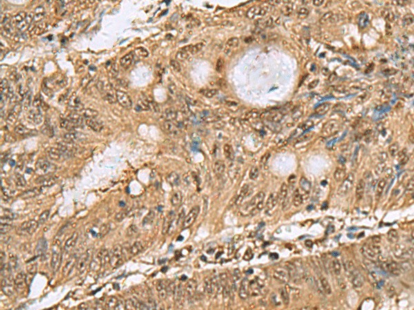 Immunohistochemistry of paraffin-embedded Human colorectal cancer tissue  using PSMA6 Polyclonal Antibody at dilution of 1:65(?200)