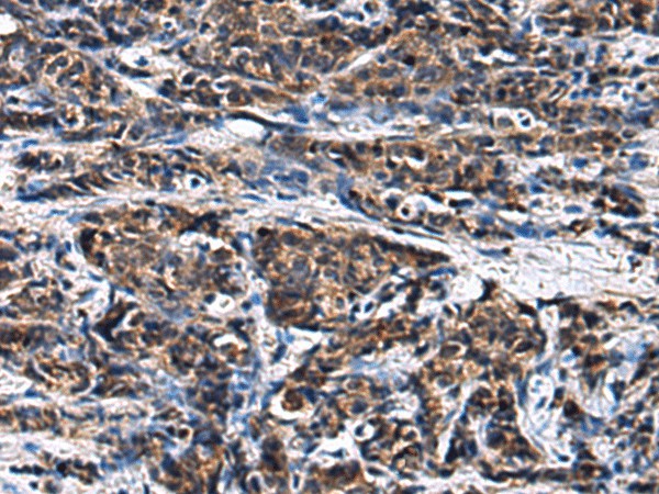 Immunohistochemistry of paraffin-embedded Human prost ate cancer tissue  using GANAB Polyclonal Antibody at dilution of 1:30(?200)