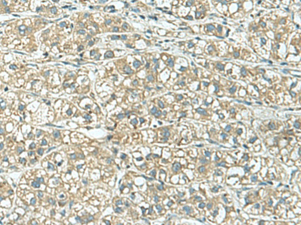 Immunohistochemistry of paraffin-embedded Human liver cancer tissue  using KCNJ2 Polyclonal Antibody at dilution of 1:25(?200)