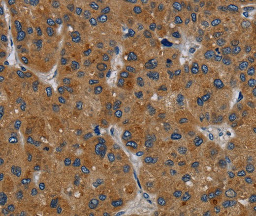 Immunohistochemistry of paraffin-embedded Human liver cancer tissue using PDGFC Polyclonal Antibody at dilution 1:40