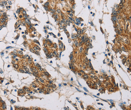 Immunohistochemistry of paraffin-embedded Human colon cancer using FXYD1 Polyclonal Antibody at dilution of 1:60