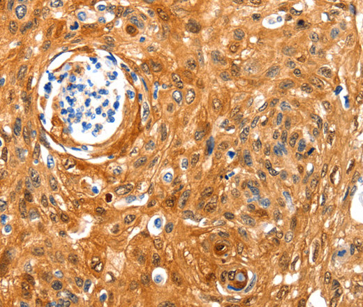 Immunohistochemistry of paraffin-embedded Human cervical cancer tissue using NCOR1 Polyclonal Antibody at dilution 1:100