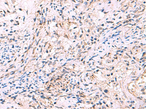 Immunohistochemistry of paraffin-embedded Human cervical cancer tissue  using INPP5B Polyclonal Antibody at dilution of 1:40(?200)