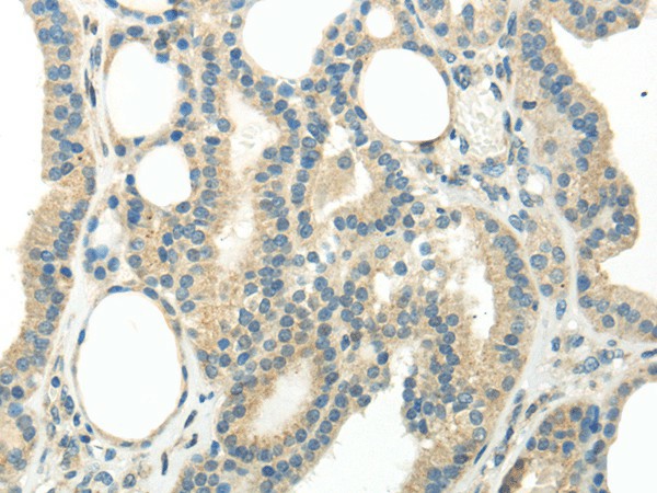 Immunohistochemistry of paraffin-embedded Human thyroid cancer tissue using WNT6 Polyclonal Antibody at dilution 1:35