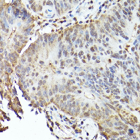 Immunohistochemistry of paraffin-embedded human colon carcinoma using TFEB Polyclonal Antibody at dilution of 1:100 (40x lens).Perform high pressure antigen retrieval with 10 mM citrate buffer pH 6.0 before commencing with IHC staining protocol.