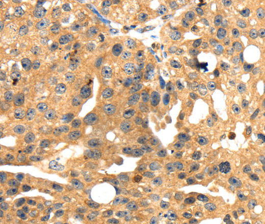 Immunohistochemistry of paraffin-embedded Human breast cancer tissue using SH3KBP1 Polyclonal Antibody at dilution 1:45