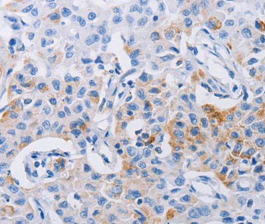 Immunohistochemistry of paraffin-embedded Human lung cancer tissue using LRIG1 Polyclonal Antibody at dilution 1:120