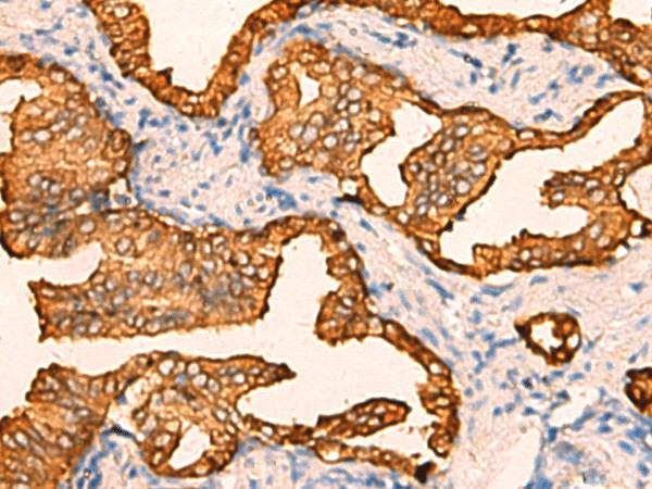 Immunohistochemistry of paraffin-embedded Human prost at e cancer tissue  using CRYM Polyclonal Antibody at dilution of 1:60(?200)