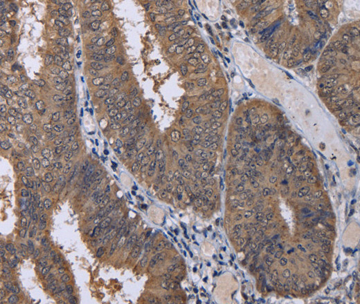 Immunohistochemistry of paraffin-embedded Human colon cancer using CUL3 Polyclonal Antibody at dilution of 1:30