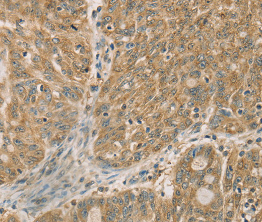 Immunohistochemistry of paraffin-embedded Human ovarian cancer using DMRT3 Polyclonal Antibody at dilution of 1:50