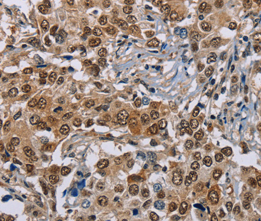 Immunohistochemistry of paraffin-embedded Human liver cancer using GTF2I Polyclonal Antibody at dilution of 1:40