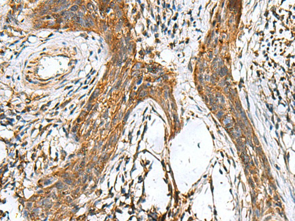 Immunohistochemistry of paraffin-embedded Human esophagus cancer tissue  using TTR Polyclonal Antibody at dilution of 1:50(?200)