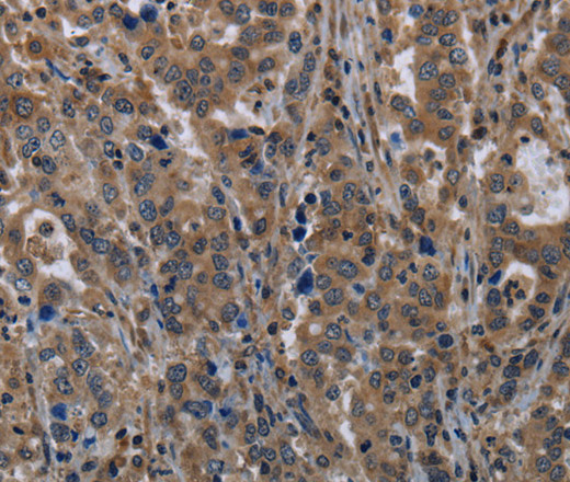 Immunohistochemistry of paraffin-embedded Human liver cancer tissue using TSC22D3 Polyclonal Antibody at dilution 1:40