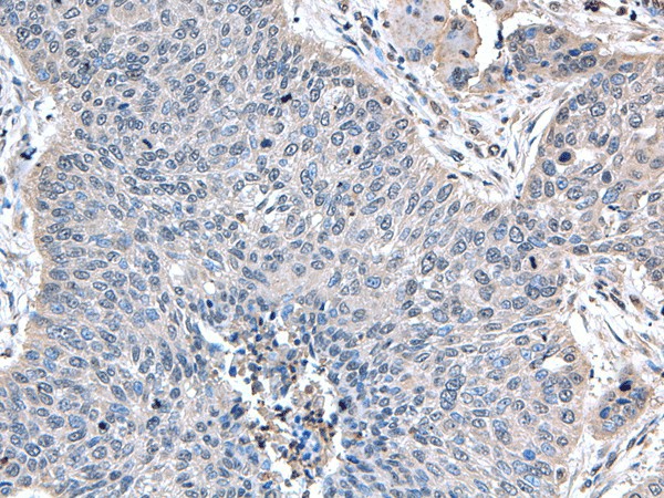 Immunohistochemistry of paraffin-embedded Human lung cancer tissue  using ZFAND5 Polyclonal Antibody at dilution of 1:35(?200)