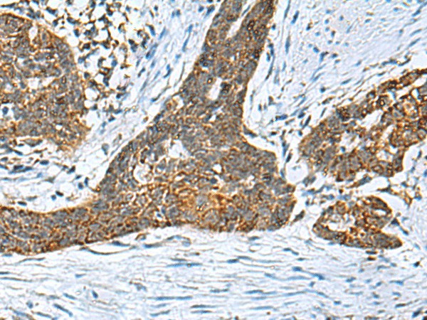 Immunohistochemistry of paraffin-embedded Human esophagus cancer tissue  using PREPL Polyclonal Antibody at dilution of 1:55(?200)