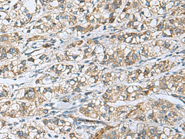 Immunohistochemistry of paraffin-embedded Human liver cancer tissue  using DNAJA4 Polyclonal Antibody at dilution of 1:50(?200)