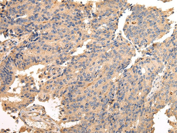 Immunohistochemistry of paraffin-embedded Human prostate cancer using SDCBP Polyclonal Antibody at dilution of  1/40