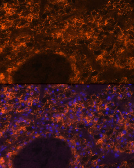 Immunofluorescence analysis of Human kidney cancer using SLC7A9 Polyclonal Antibody at dilution of 1:100. Blue: DAPI for nuclear staining.
