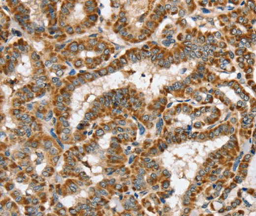 Immunohistochemistry of paraffin-embedded Human thyroid cancer using PPOX Polyclonal Antibody at dilution of 1:40