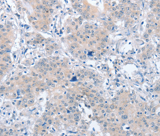 Immunohistochemistry of paraffin-embedded Human gasrtic cancer tissue using PARD6A Polyclonal Antibody at dilution 1:60