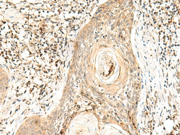 Immunohistochemistry of paraffin-embedded Human esophagus cancer tissue  using POLR1E Polyclonal Antibody at dilution of 1:40(?200)